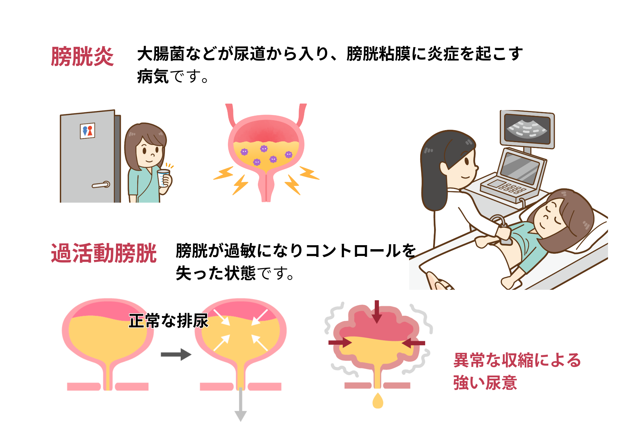 過活動膀胱と頻尿